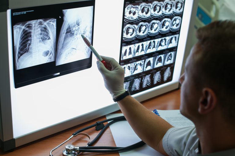 Read more about the article Bronchiectasis: How to Care for Your Lungs