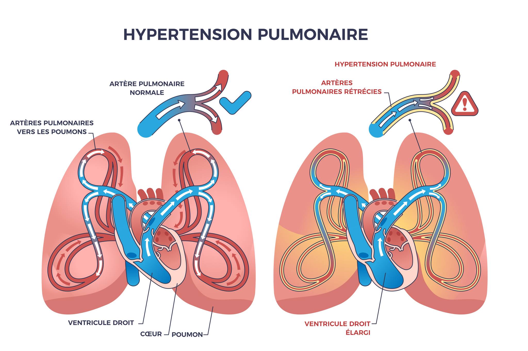 Hypertension Pulmonaire Diagnostic et Traitement Précoces — free download