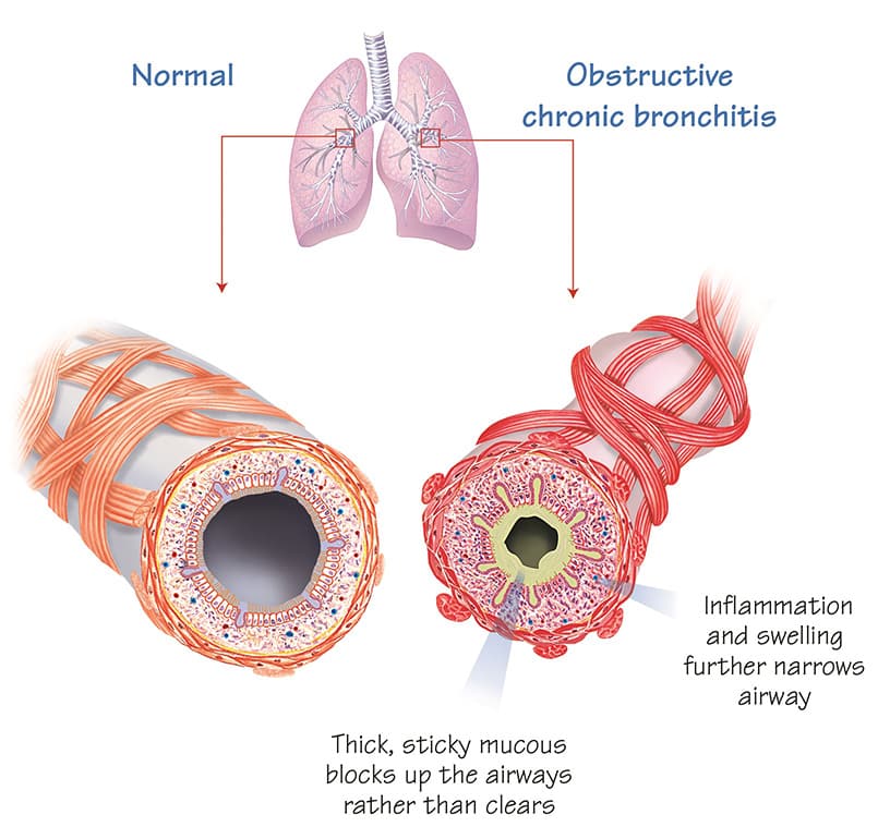What is COPD?