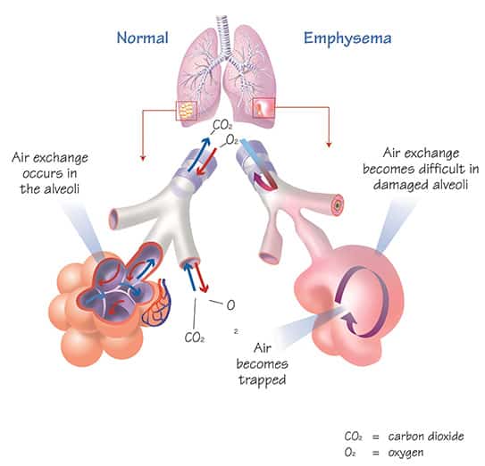 What is emphysema?