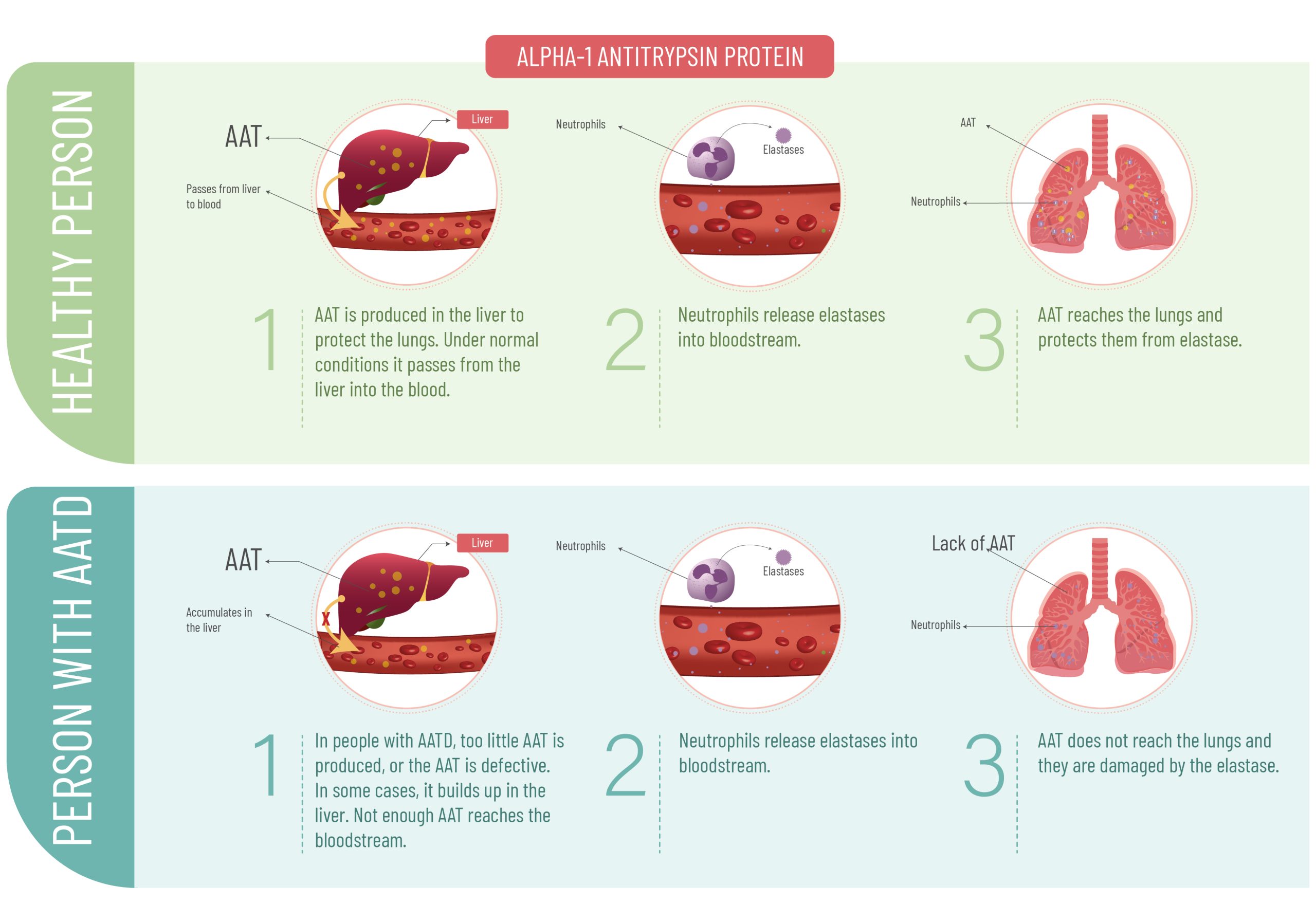 what is aatd Alpha-1 antitrypsin protein