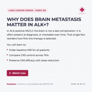 ALK positive NSCLC brain metastasis